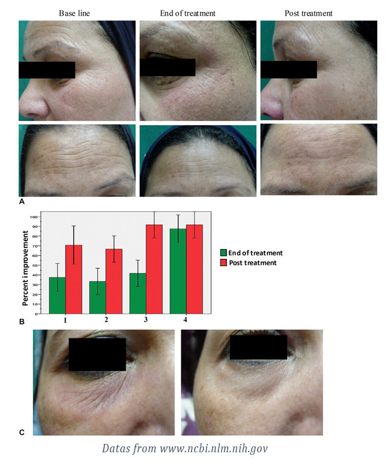 During a Rf therapy treatment, the short pulses of energy flow into the skin and transmit to the deeper layer of your skin called dermis,will The RF energy  will gently and safely stimulate the production of collagen to help improve signs of wrinkles and sagging skin, as well as an increase in the body’s natural hyaluronic acid production. Look at the following study’s result, the treatment of RF therapy is quite significant.The wrinkle and fine lines have a great improvement at the end and the post of treatment.